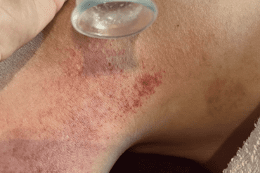 Verlicht stress en hoofdpijn op een natuurlijke manier met Transformational Cupping!